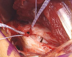 Internal Brace Repair 2