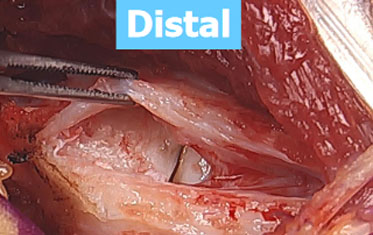 distal 2