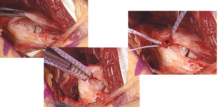 Internal Brace Repair1