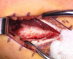 Ligament Exposure 1