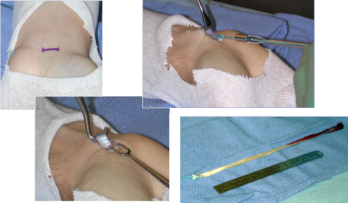 palmaris-graft