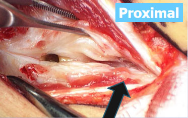 proximal 1
