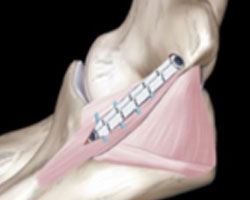UCL Repair pic